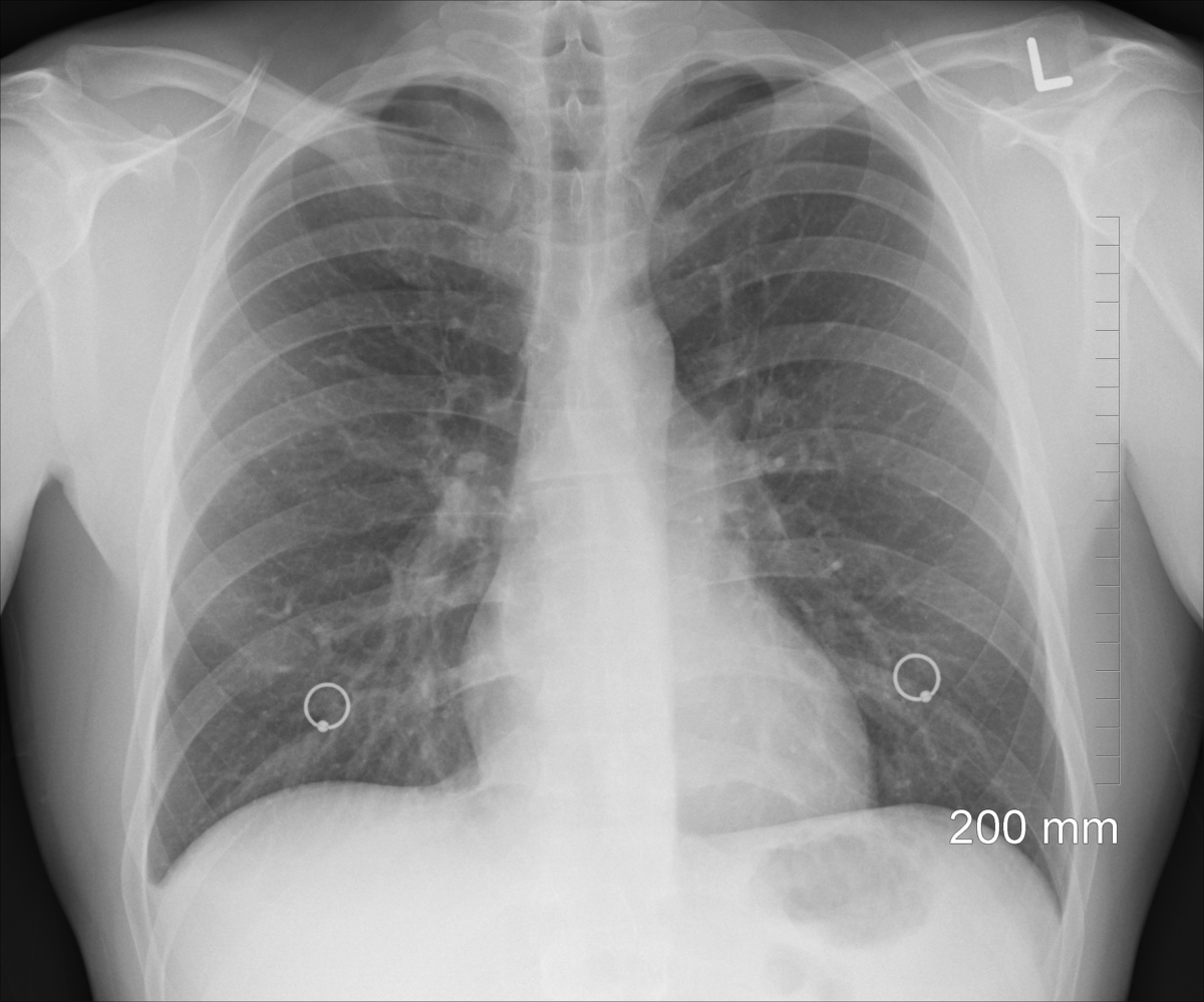 Na última semana de março infecções respiratórias quase triplicaram no Paraná