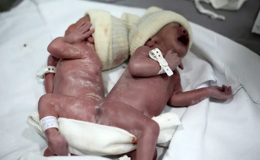 Gêmeos siameses nascem em Campo Largo; médicos ainda não sabem se poderão separá-los